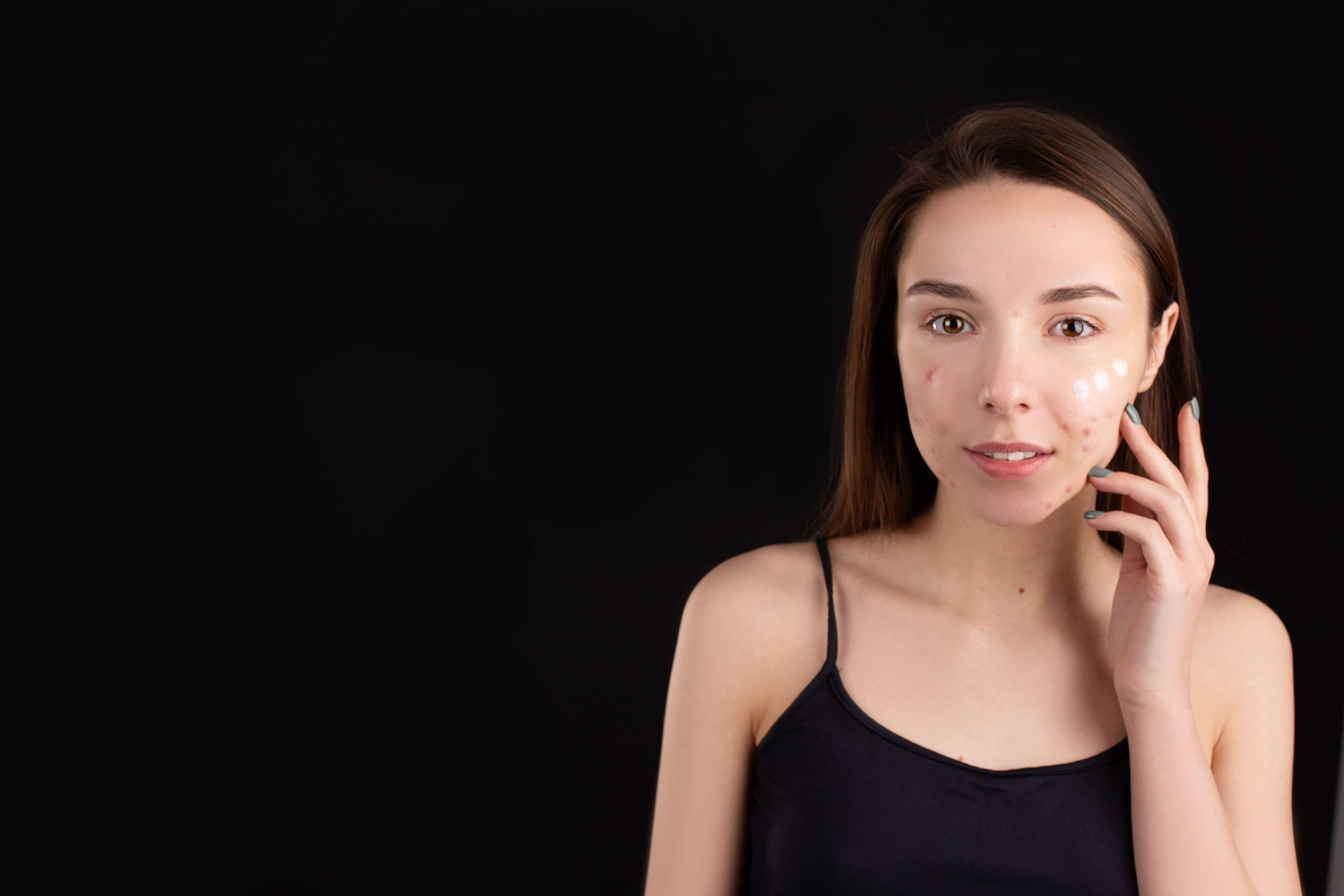 Effective Ways to Treat Hormonal Acne: A Comprehensive Guide