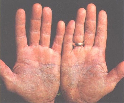 Soothing Solutions: Skincare Tips for Managing Psoriasis