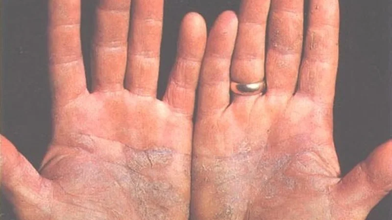 Soothing Solutions: Skincare Tips for Managing Psoriasis